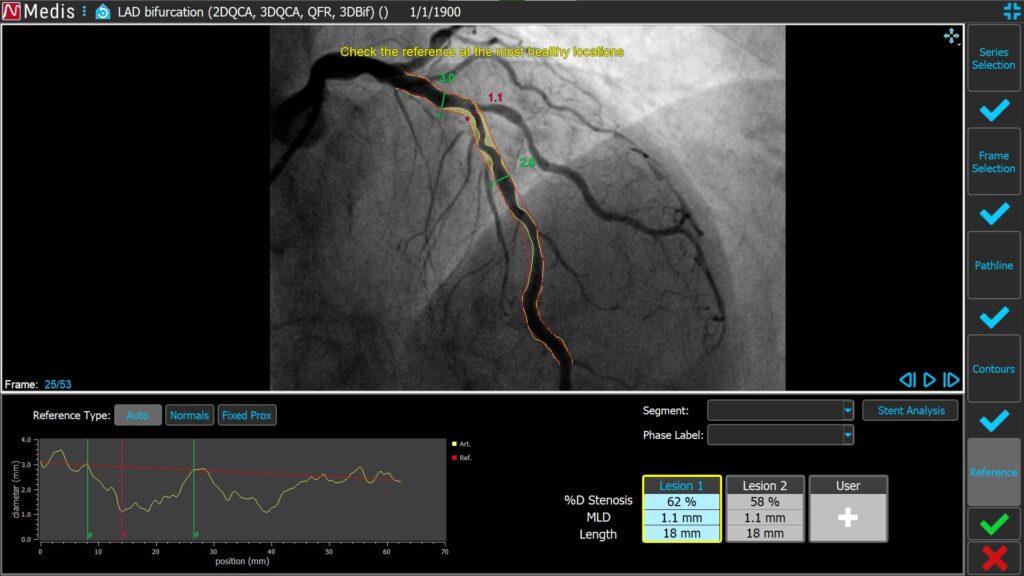 Medis Suite XA 3D QCA Single Vessel 5 Reference 2D