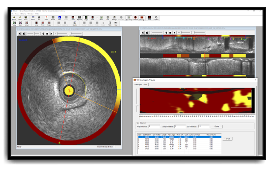 Medis Intravascular product screen